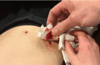 T1D blood belly